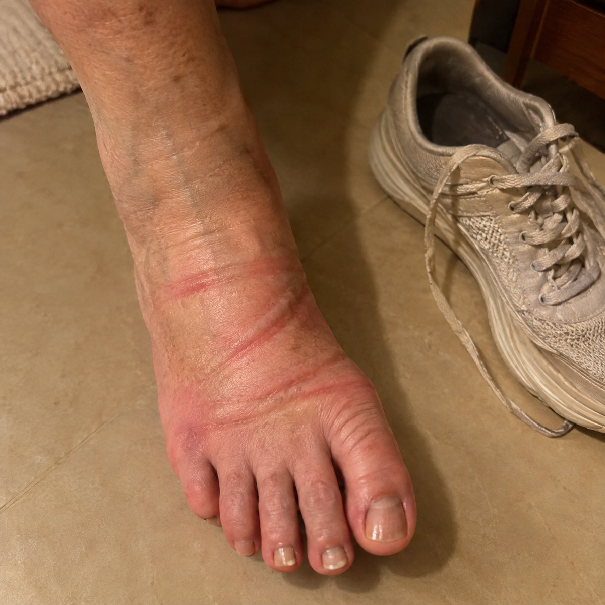 Un pied gonflé marqué par les lacets, à côté de sa chaussure